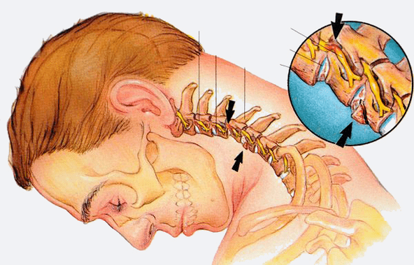 estágios de osteocondrose da coluna cervical